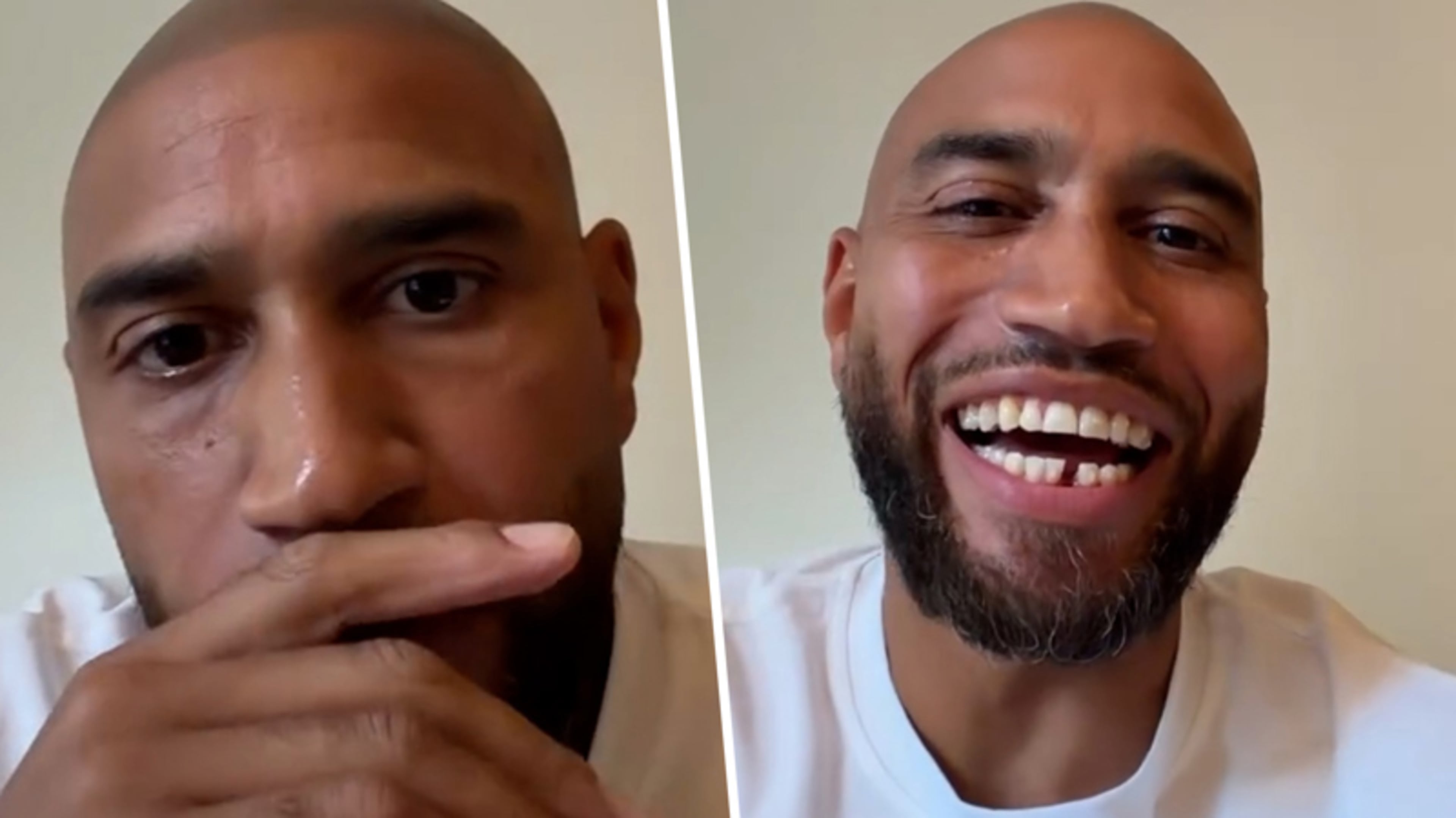 Edson da Graça onthult gebit na ingrijpende ingreep: ‘Wees gewoon eerlijk in de comments’