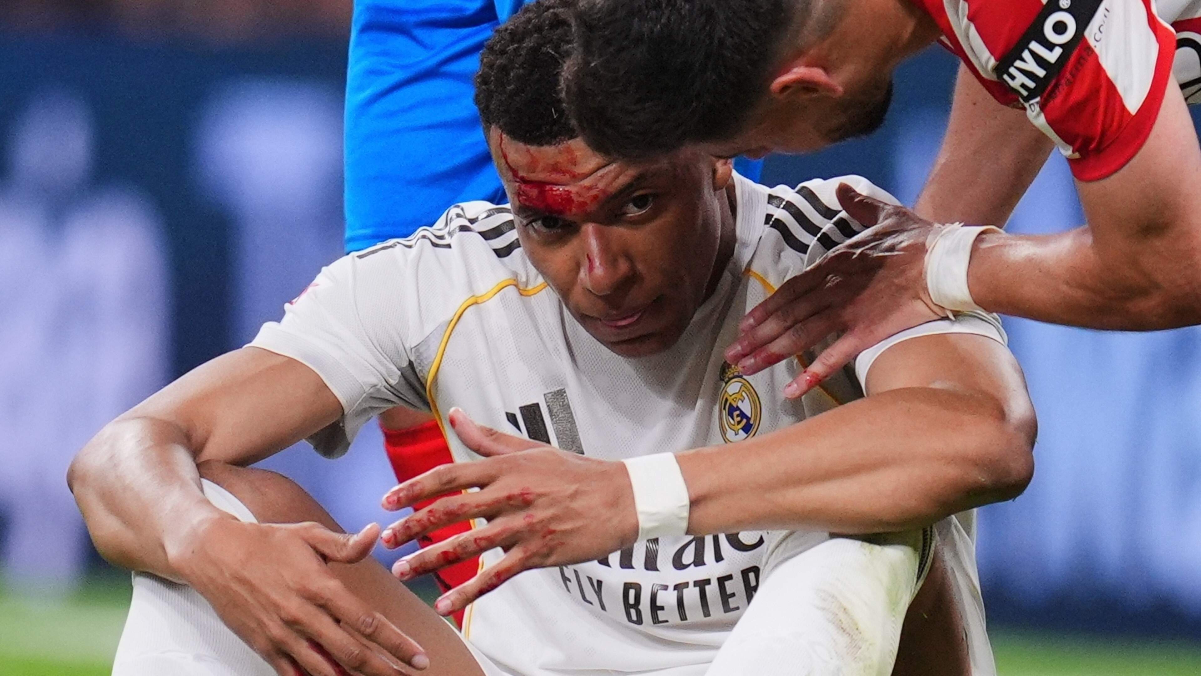 Hevig bloedende Kylian Mbappé loopt met Real Madrid opnieuw averij op in strijd om Spaanse landstitel