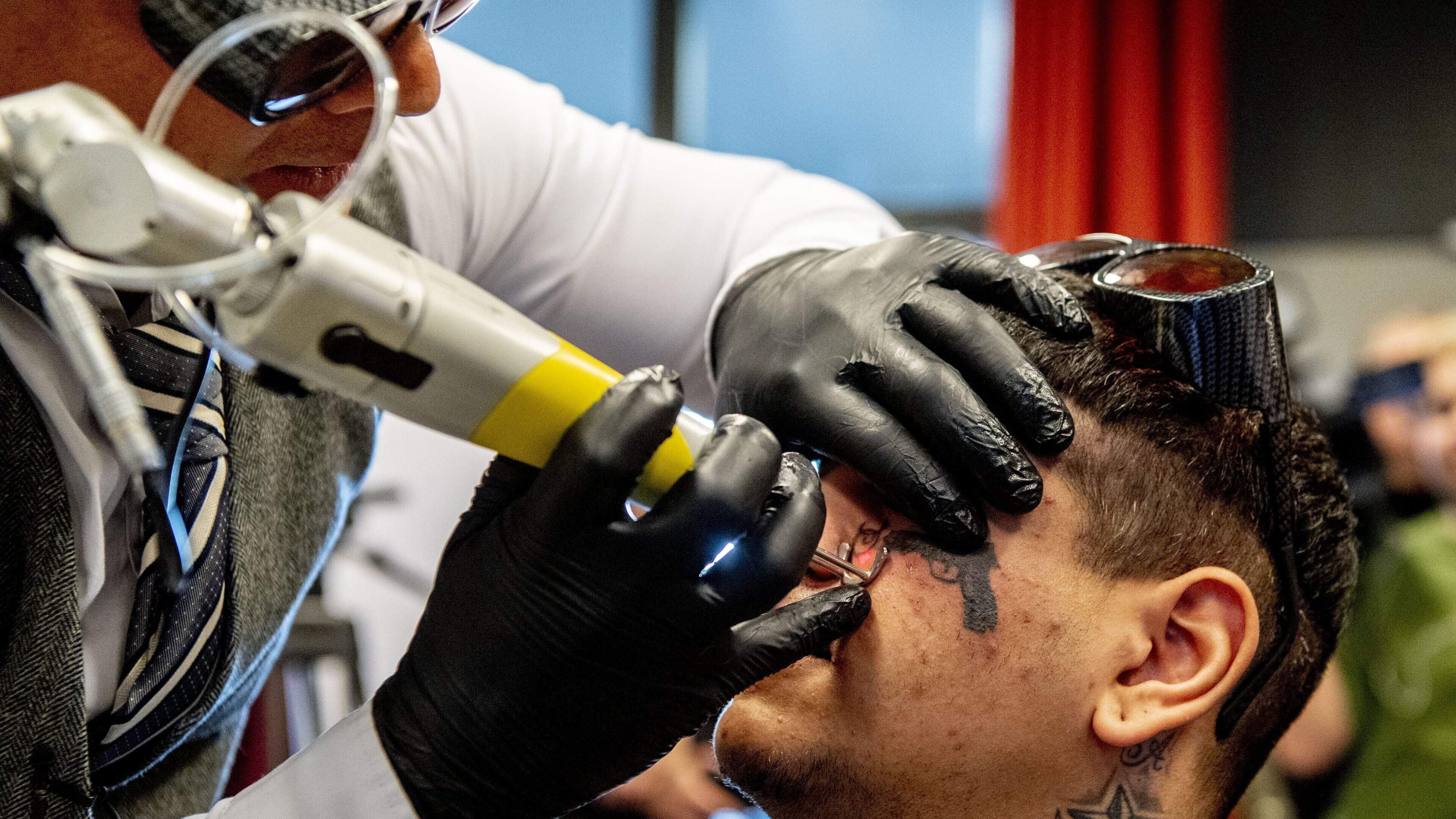 Tattooverwijderaar zonder papieren verminkt klanten: ’Littekens blijven’