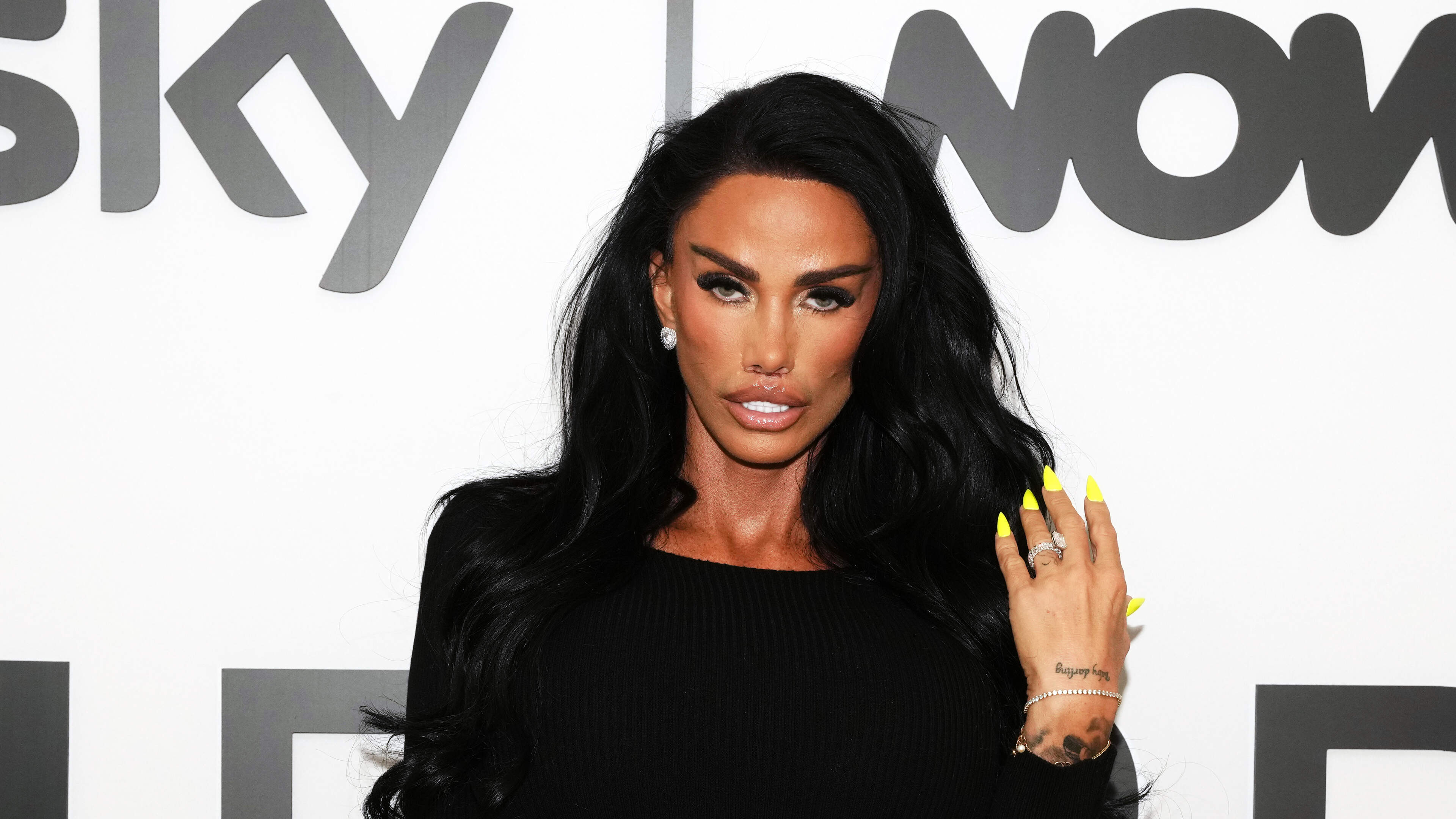 Katie Price laat resultaat van nieuwe liplift zien na pijnlijke operatie